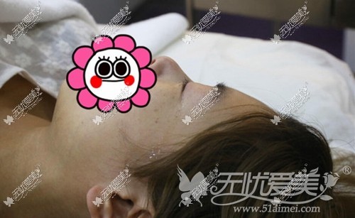 小莹在广州华美接受激光去肥胖纹手术