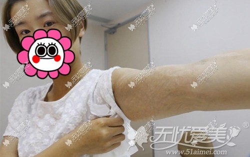 小莹在广州华美接受激光去肥胖纹前
