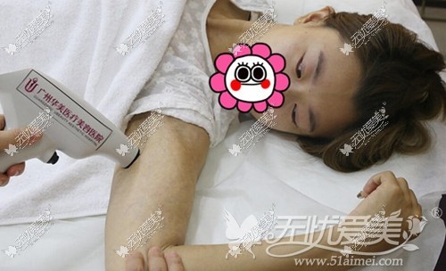 小莹在广州华美接受激光去肥胖纹手术过程