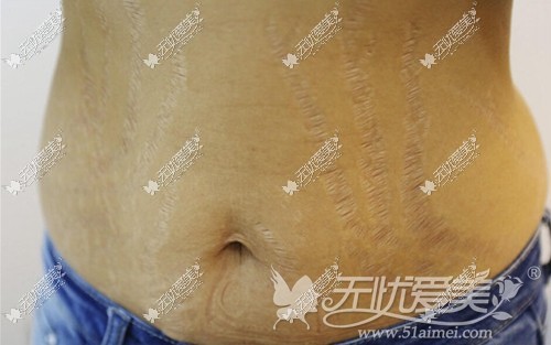 小莹在广州华美接受激光去腰腹部肥胖纹