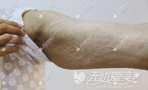 小莹在广州华美接受激光去胳膊肥胖纹