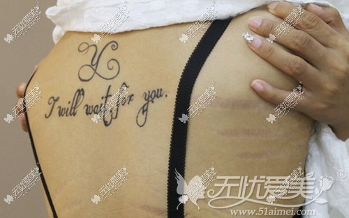 小莹在广州华美接受激光去背部肥胖纹手术