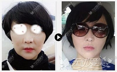朴明旭院长的小切口三重面部提升术案例