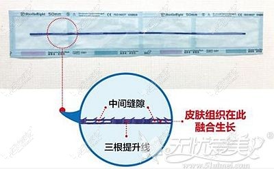小切口三重面部提升术的优势