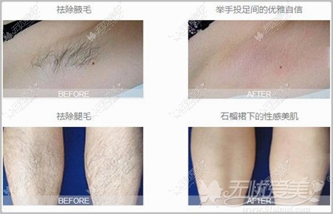 内江瑞美冰点激光脱毛案例 内江瑞美冰点激光脱毛案例