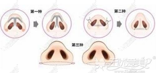 鼻翼缩小的三种方法