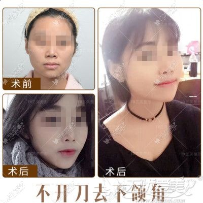 不开刀说下颌角对比图