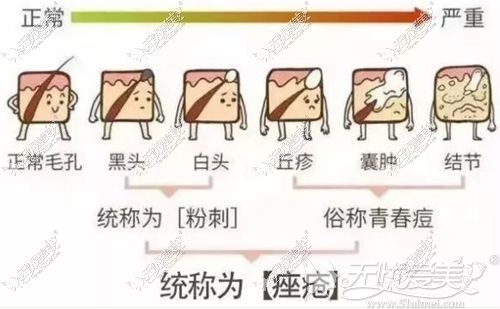 痘痘的种类