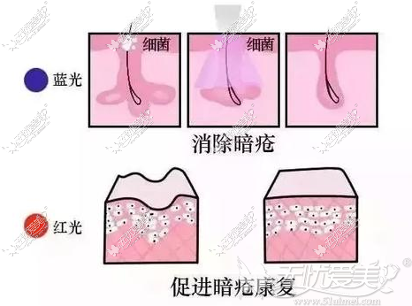 红蓝光去痘痘的治疗效果