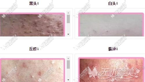各种痘痘的的样子