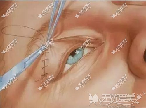 埋线双眼皮所用的线材