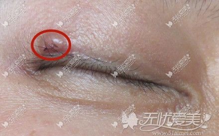 埋线双眼皮线头线结反应