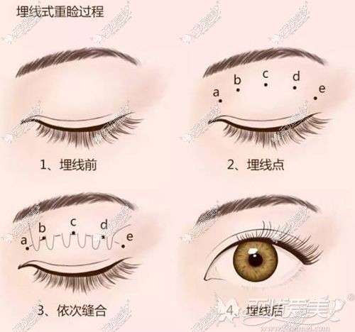 埋线双眼皮手术原理