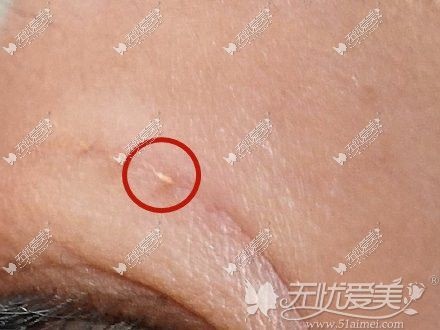埋线线结外露图片