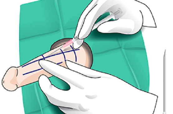 手术费用参考与价值分析