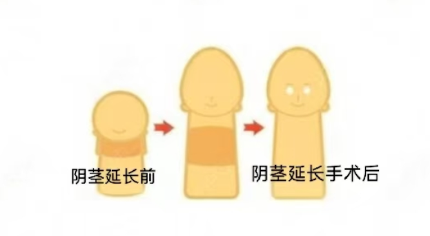 张国喜医生假体三件套具体手术费用