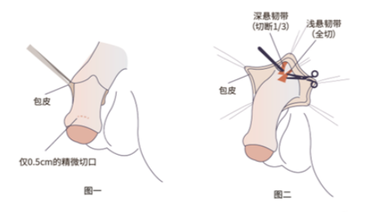 假体三件套价格相关注意事项