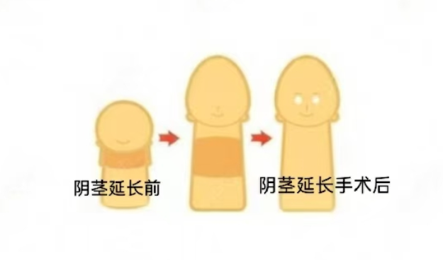 王文卫增粗手术具体价格明细