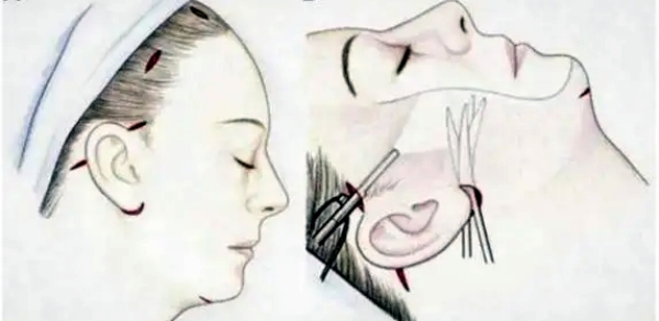 北京加减美V9手术