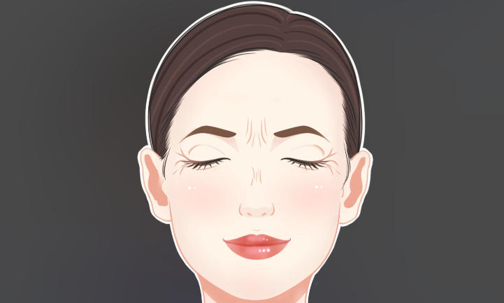 李广学真皮填充川字纹术费用多少