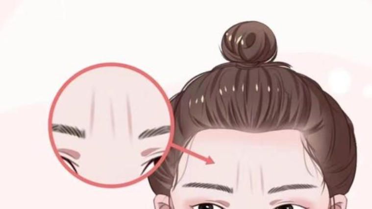 李广学真皮填充川字纹术费用多少?市场统一价3000元起,网上可约