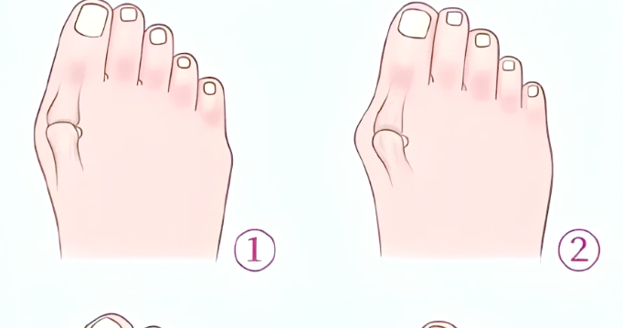 温建民与苏敬达做拇外翻手术选谁更合适