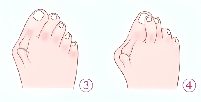 温建民做拇外翻患者真实反馈