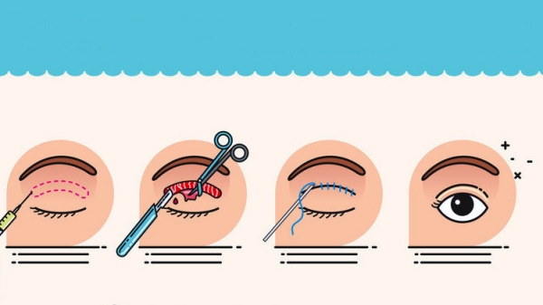 梁伟中眼睛手术花了2万多正常吗?结合项目和收费体系判断,眼整形价格多数时候属正常范围