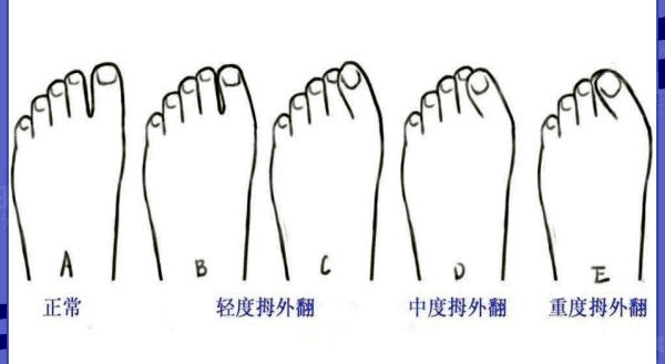 温建民治拇外翻是哪种方案？中西医结合微创，不截骨不打钢钉