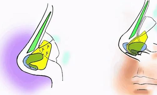 杭州做肋骨鼻多少钱？半肋骨隆鼻3万起，全肋骨隆鼻5万元起