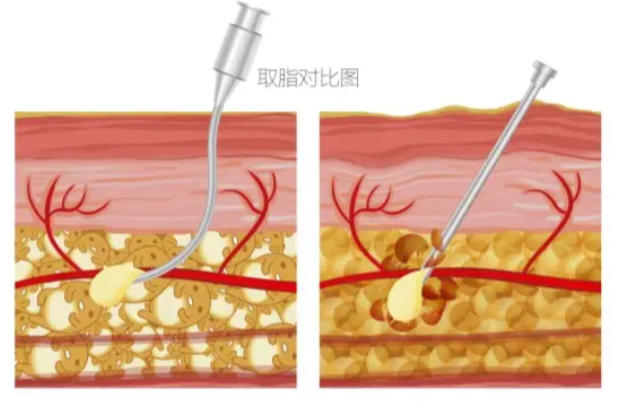 冯斌和王东哪个更擅长做脂肪填充手术？王东性价比高，冯斌医生小红书上多人种草