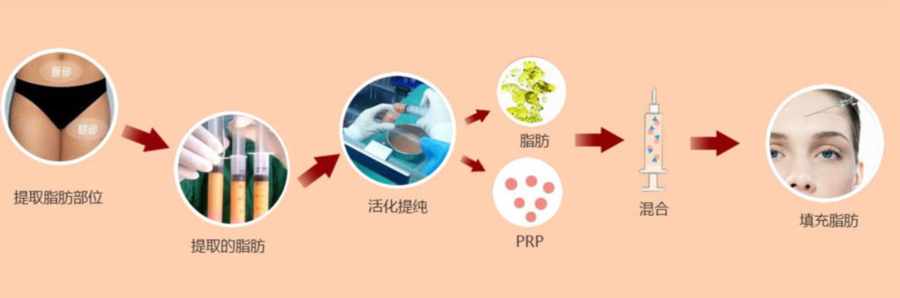 北京脂肪填充行业现状