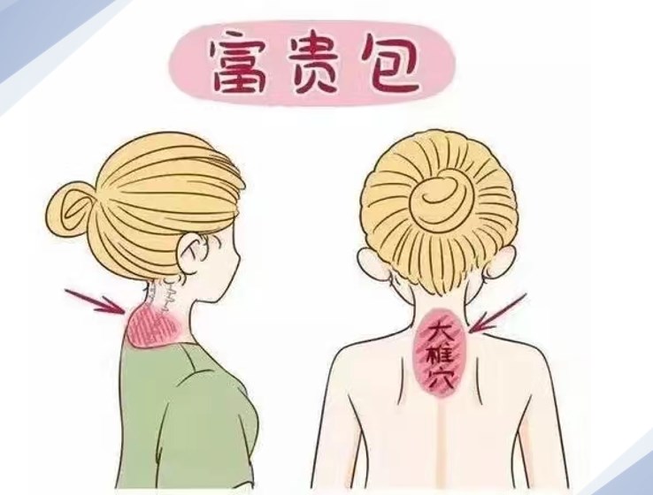 曹孟君治疗富贵包价格体系详解
