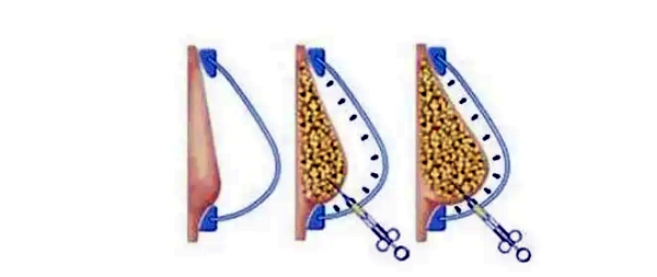 广州胸部生长因子取出