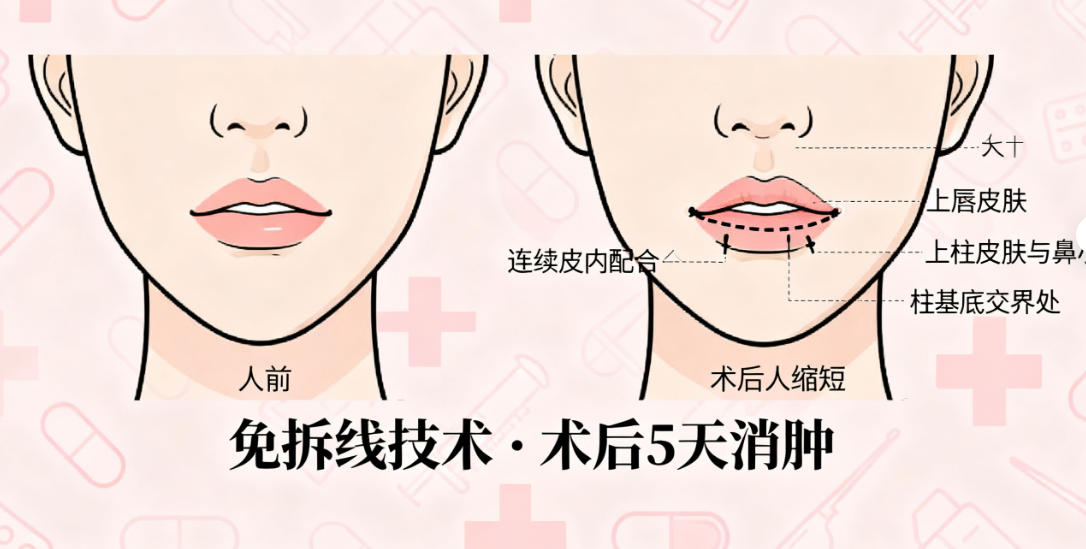 深圳福雅医疗美容做人中哪个医生好？胡俊杰人中缩短术真实案例曝光，术后幼态感强