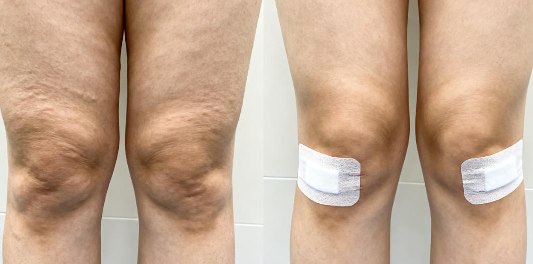 深圳曹孟君医生大腿吸脂科普：土麦森技术1.58万起恢复期免穿塑身衣