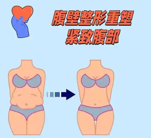 腹壁成型手术价格影响因素