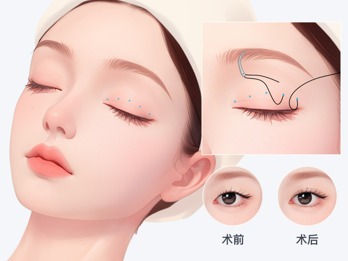 修复双眼皮