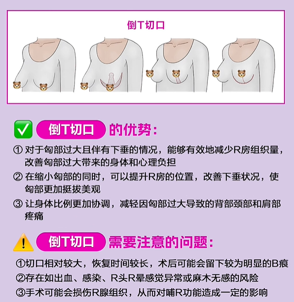 二、为什么会出现胸下垂?了解原因才能对症改善