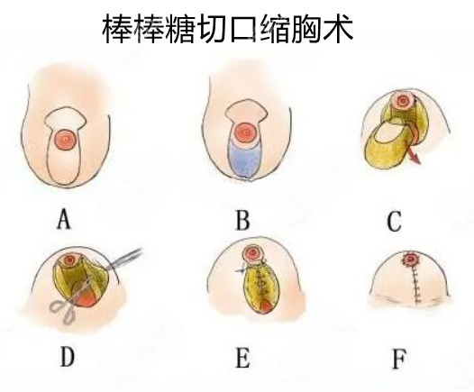 不隆胸的情况下怎么改善胸下垂?5种物理矫正法