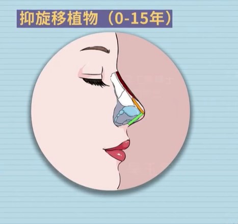 隆鼻
