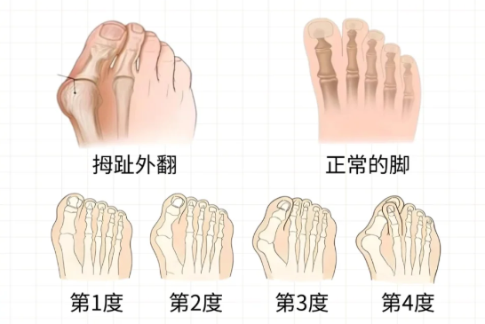 一、北京拇外翻曹海锟医生怎么预约？24小时电话+免费在线双渠道任选