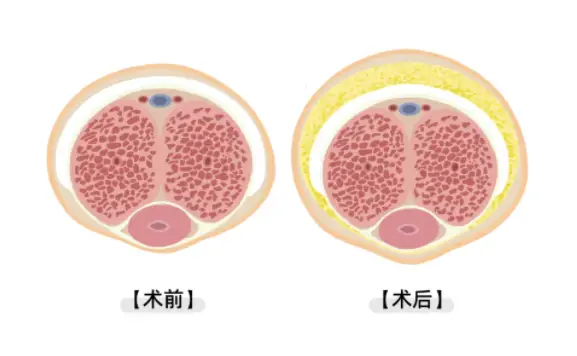 二、影响阴茎增粗手术价格的主要因素