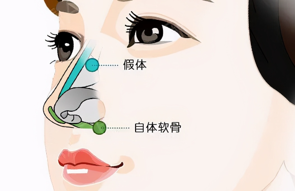 宝鸡地区隆鼻选择需综合考虑医院资质