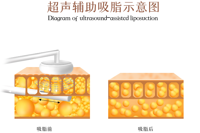 南京艺星陈孝闯抽脂谁做过？真实范例+创口贴吸脂技术解析