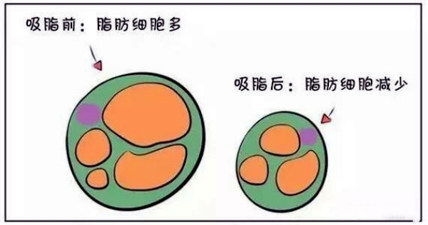 北京纯脂医疗美容医院吸脂技术