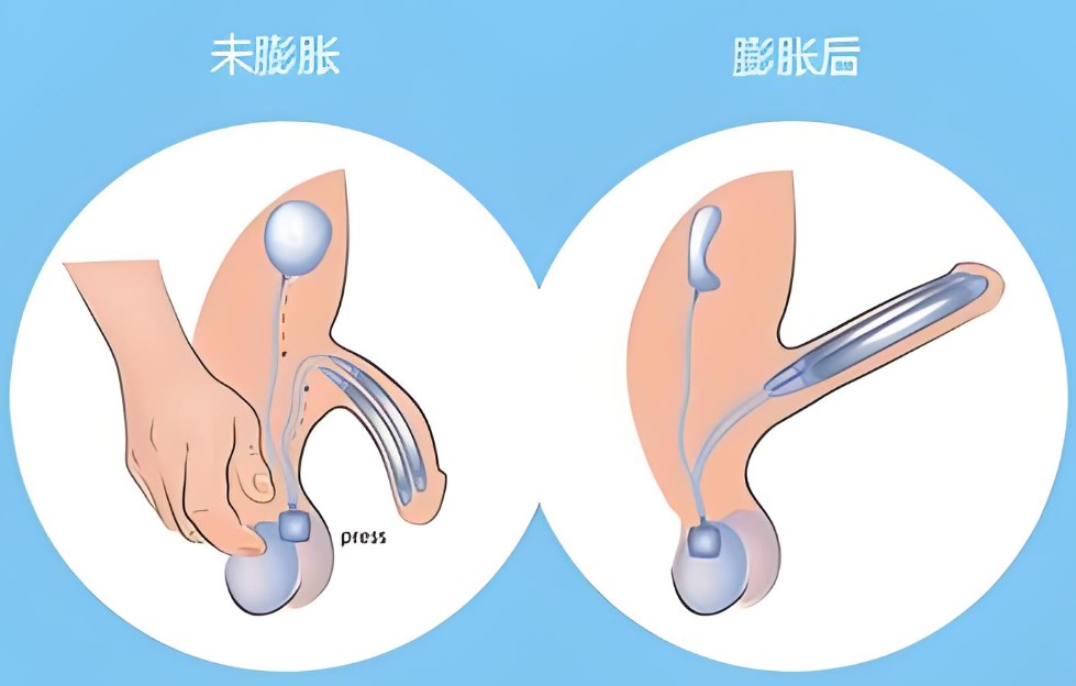 李世荣医生做阴茎再造手术多少钱