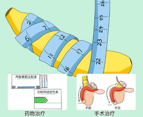 二、阴茎再造手术到底是什么？别跟普通延长增粗搞混了