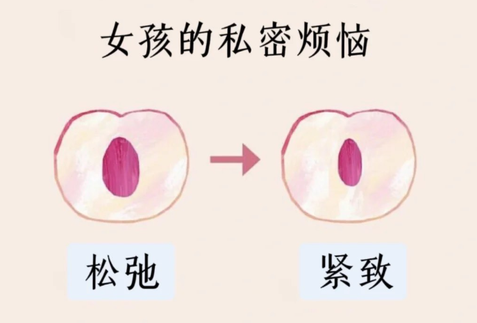 四、杭州缩紧针的价格是多少？费用构成全解析