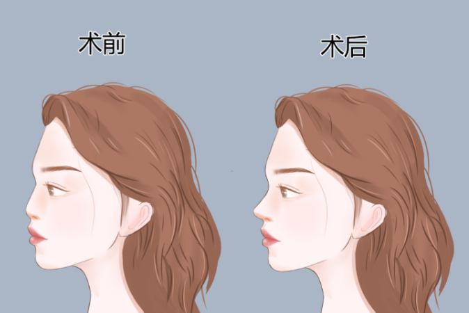 重庆当代王旭明隆鼻价格我拿去跟成都的比了一哈,咋说呢,这个钱花得还是重庆巴适